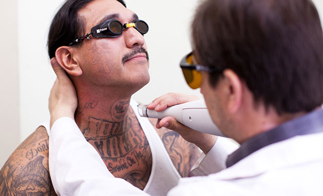Doctor Removing Tattoo from Man